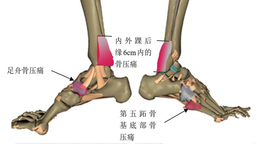 如何治疗胫骨应力综合症