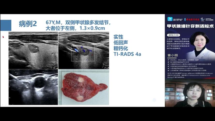 甲状腺穿刺结果怎么分辨