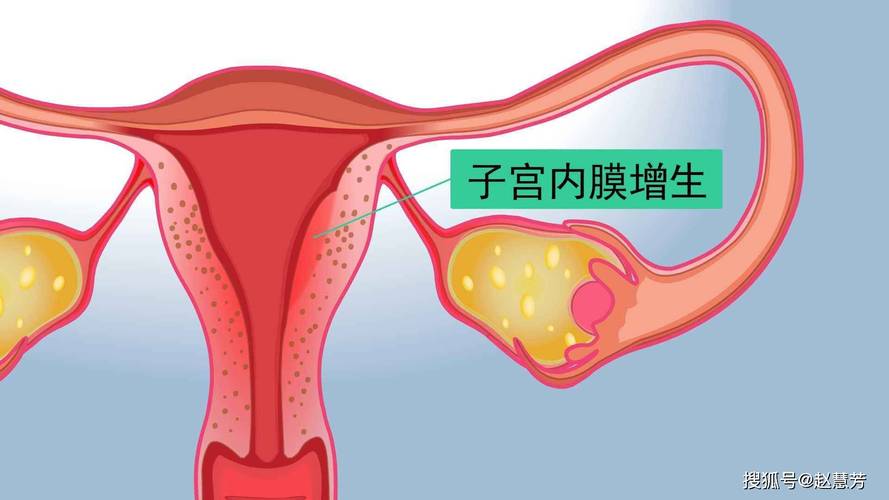 内膜增厚是什么原因造成的