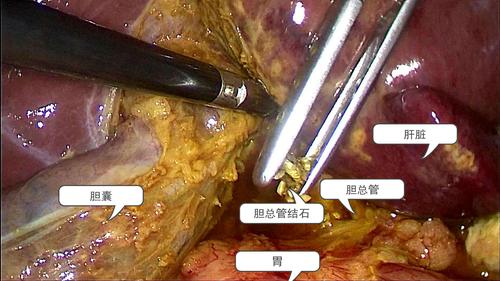 胆囊切除后有什么影响