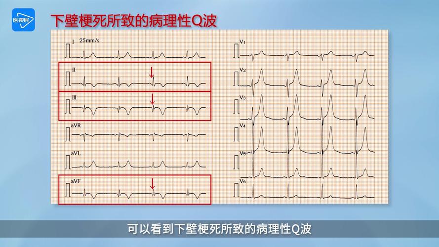 T波改变心电图说明什么问题