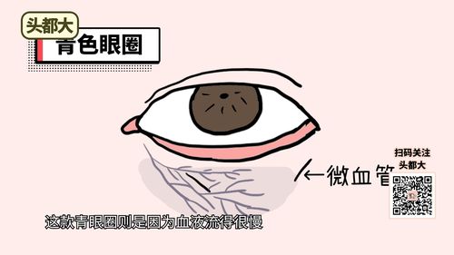 黑眼圈是什么原因