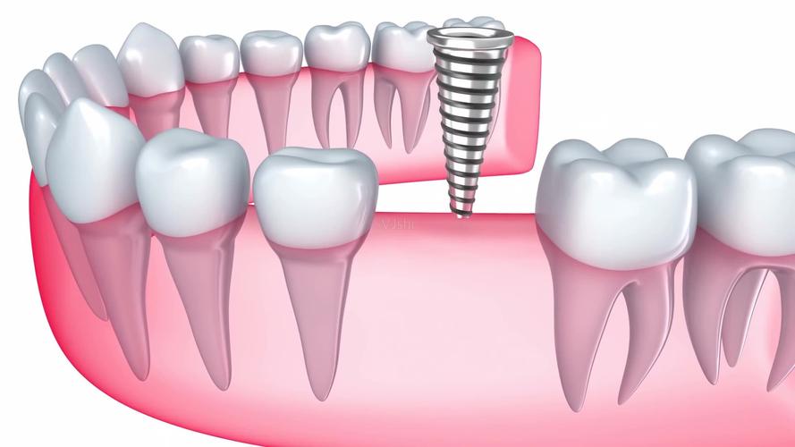 种植牙有什么风险和后遗症