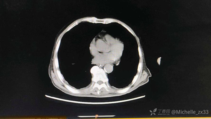 ct高密度影是什么意思