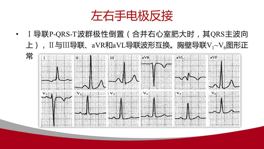 心电图q波异常什么意思