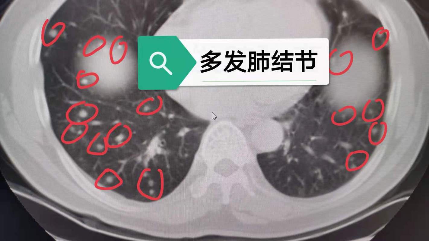 肺下叶结节是什么意思