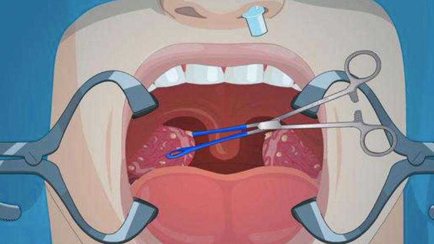 检查扁桃体做什么检查