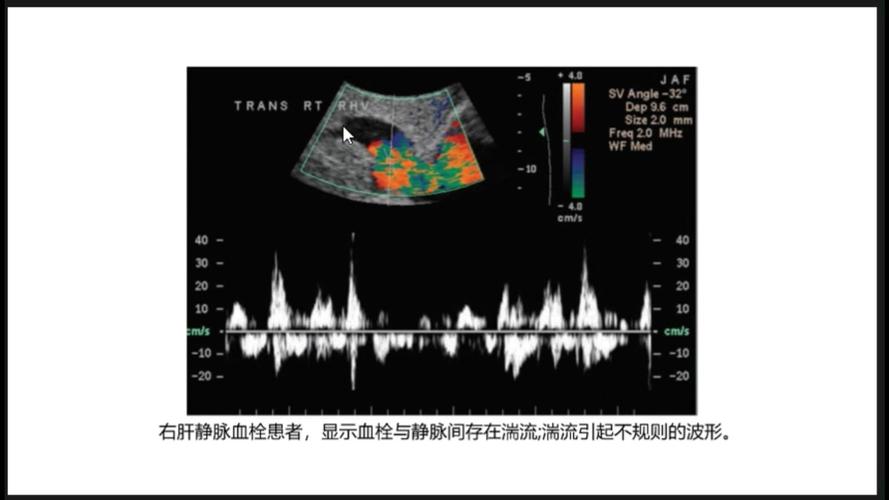 见血流信号是什么意思