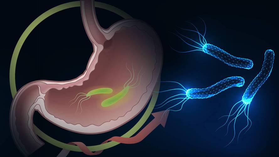 幽门螺旋杆菌什么症状