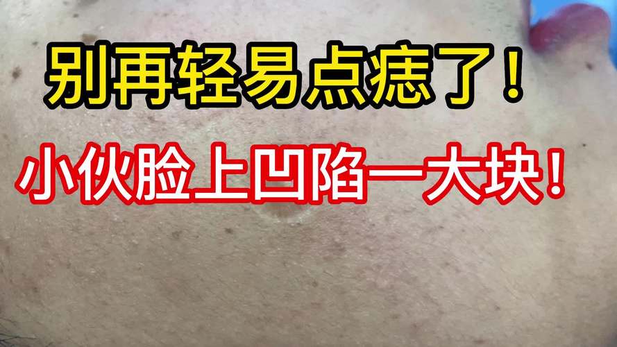 点痣留下的凹陷坑怎么修复