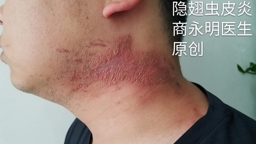 臭虫是怎么长出来的